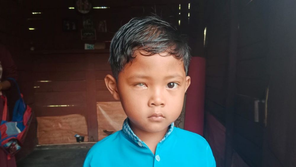 Anak Penjual Sapu di Tanggamus Derita Katarak Sejak Usia 2 Tahun