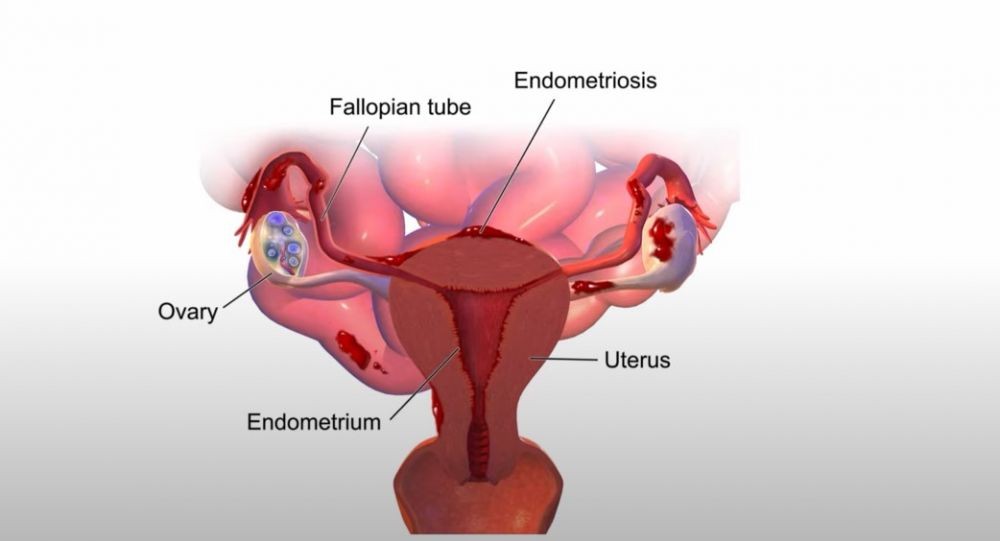 Endometriosis fotos reales