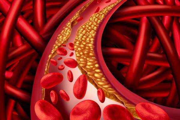 8 Komplikasi Kolesterol Tinggi dan Cara Mencegahnya
