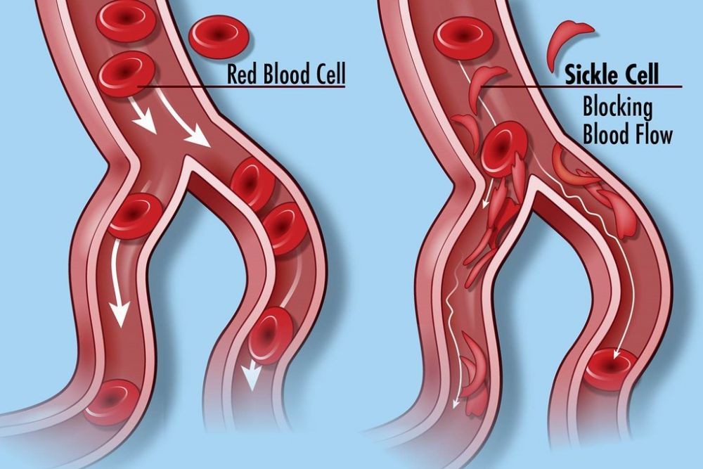 Can You Have Anemia With Normal Blood Test