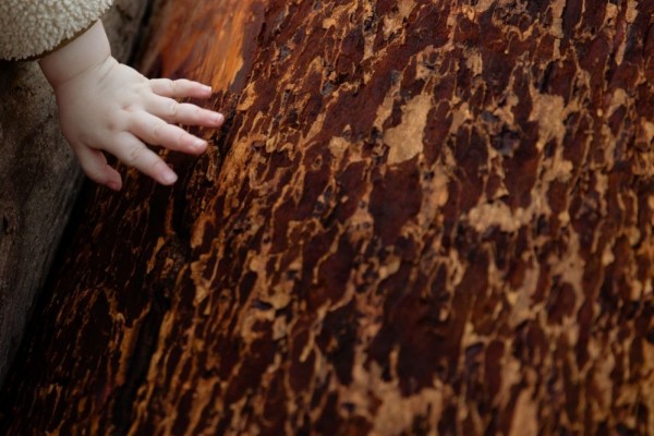Epidermodysplasia Verruciformis: Gejala, Diagnosis, Pengobatan