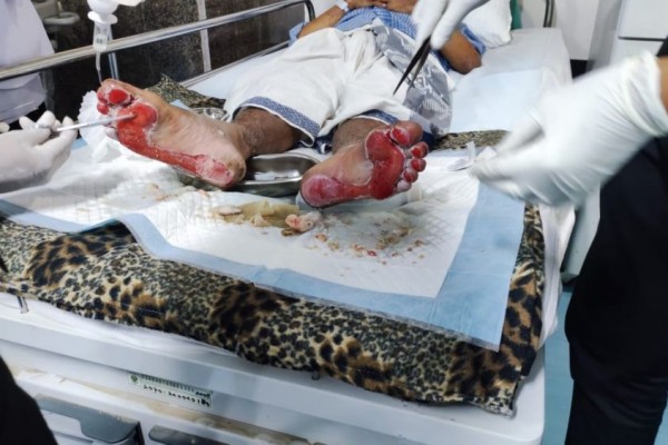 Kaki Jemaah Haji Melepuh, Suhu di Arab Saudi 50 Derajat Celcius