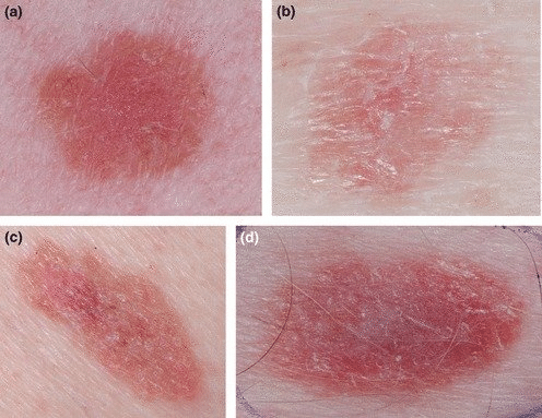 Melanoma Amelanotik: Gejala, Penyebab, Pengobatan