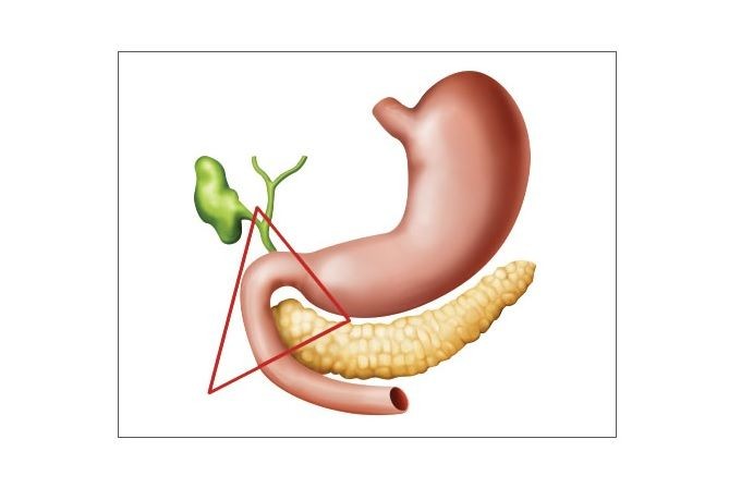 Gastrinoma: Gejala, Penyebab, Diagnosis, Pengobatan