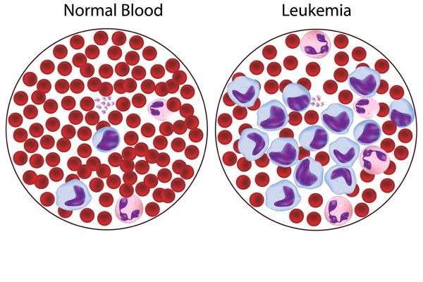 Leukemia Limfoblastik Akut: Penyebab, Gejala, Pengobatan