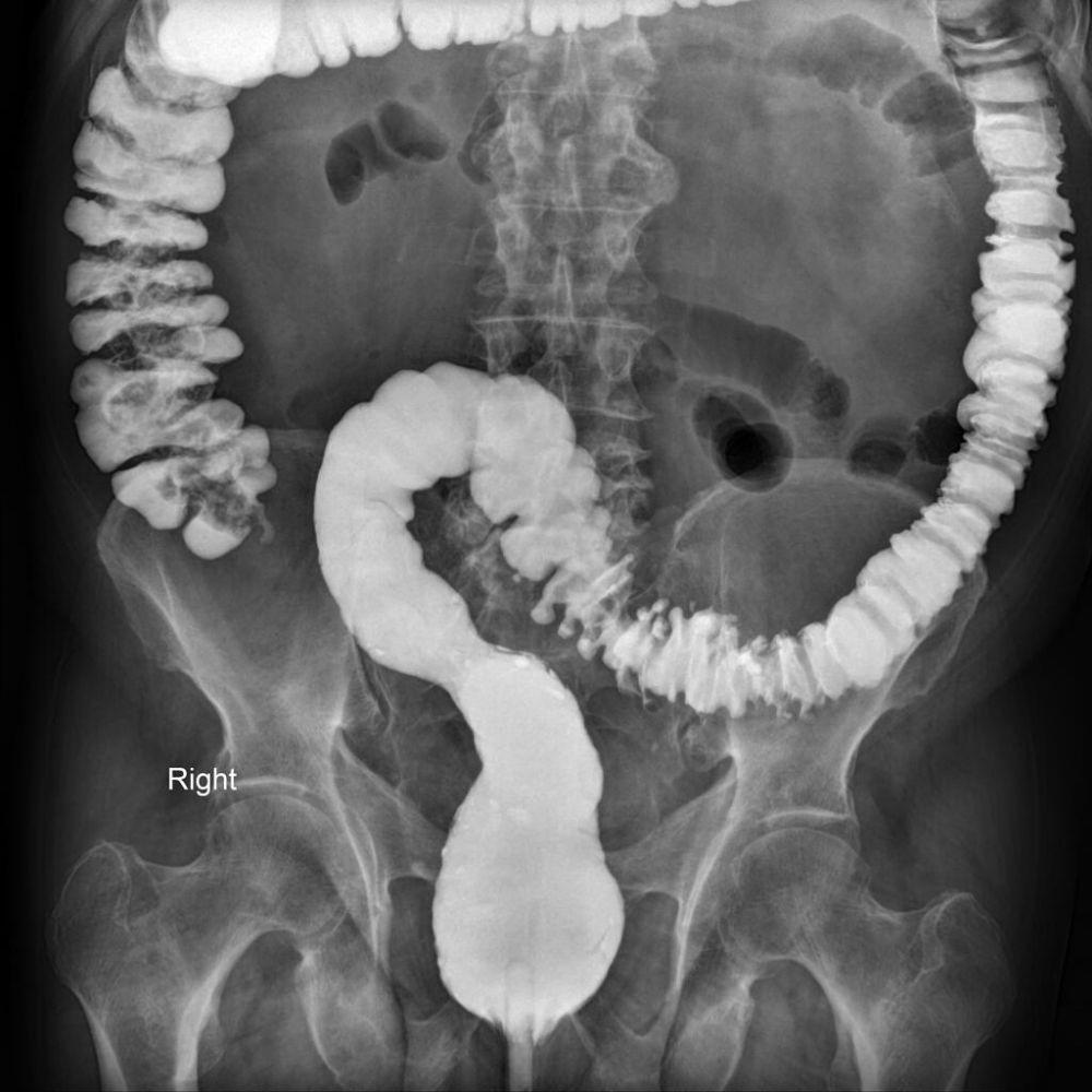 barium-enema-tujuan-persiapan-prosedur-risiko