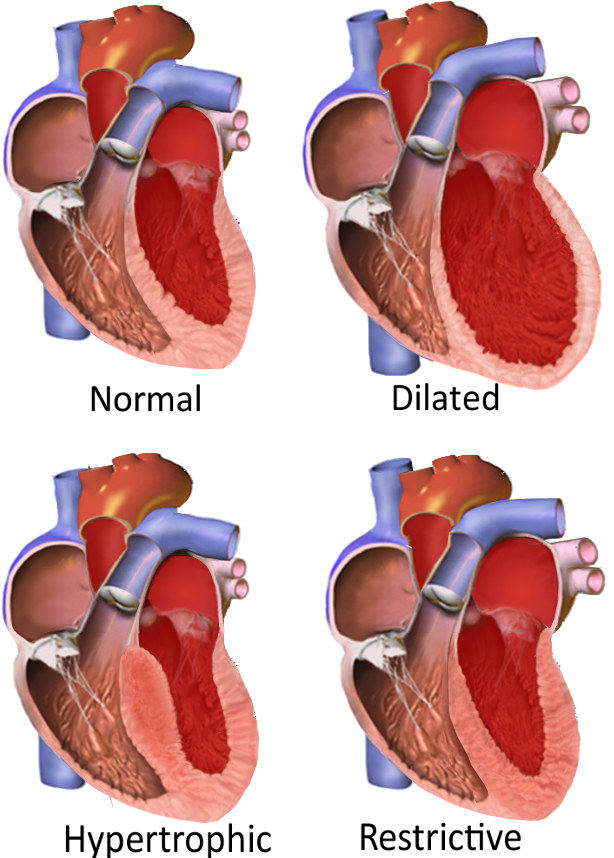 Kardiomiopati: Penyebab, Gejala, Diagnosis, Perawatan