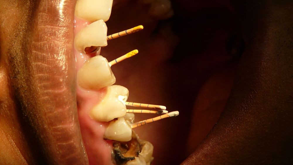 Perawatan Saluran Akar Gigi, Kapan Diperlukan?