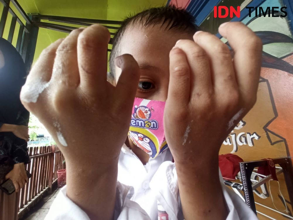 Penyakit Scabies yang Masih Menyerang Siswa SD di Banjarmasin