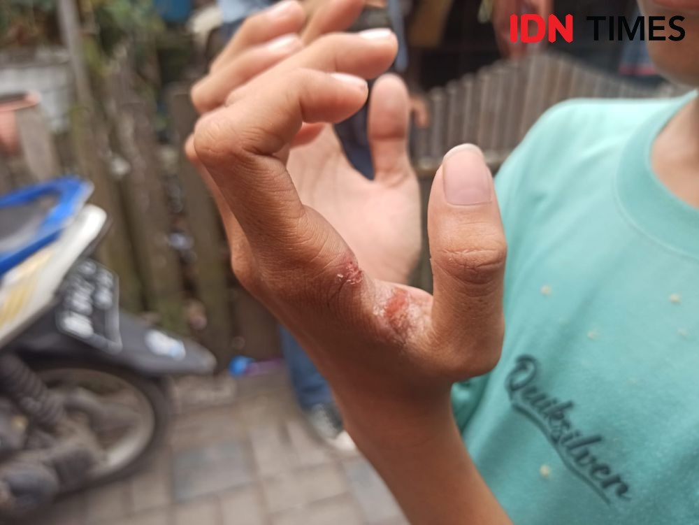 Puluhan Siswa di SDN Banjarmasin Terpapar Penyakit Kulit Scabies 