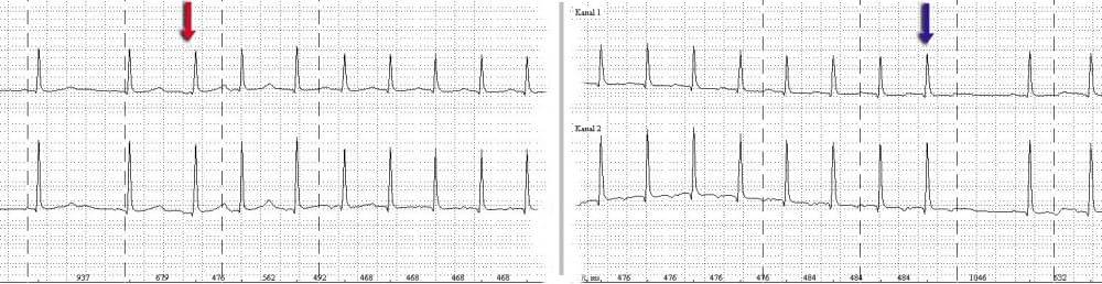 Supraventricular Tachycardia: Gejala, Penyebab, Pengobatan