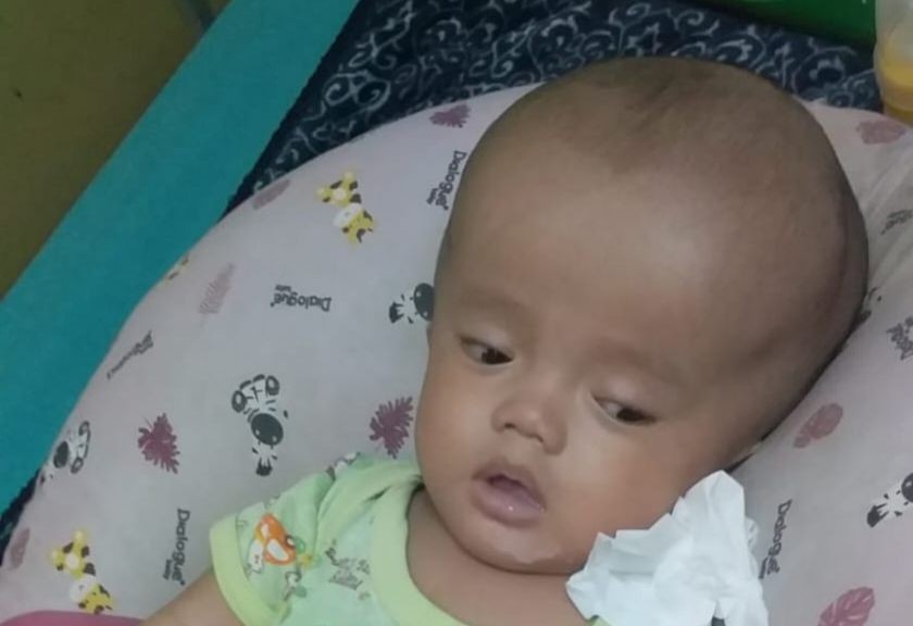 Bayi di Lamongan Menderita Hidrosefalus, Orangtua Berharap Keajaiban