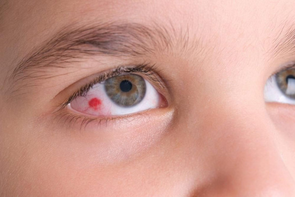 7 Penyebab Bercak Merah pada Mata, Apakah Normal?
