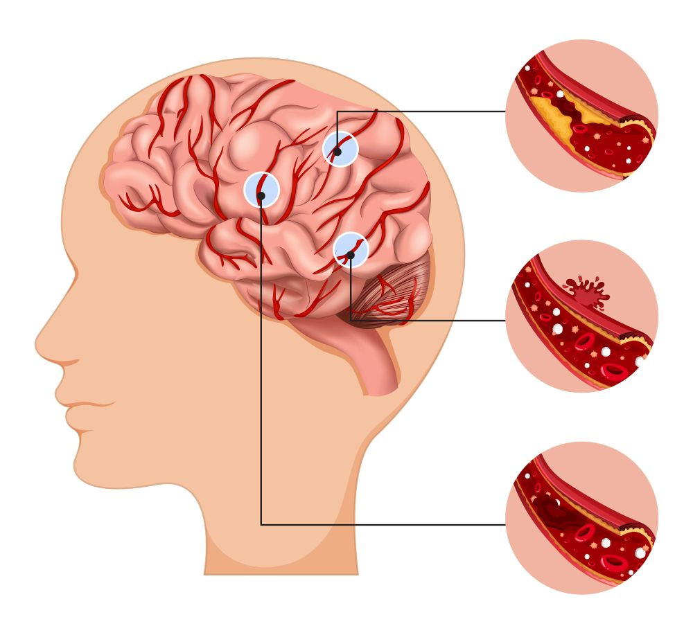 5 Alasan Hipertensi pada Usia Muda Penyebab Otak Rusak saat Tua