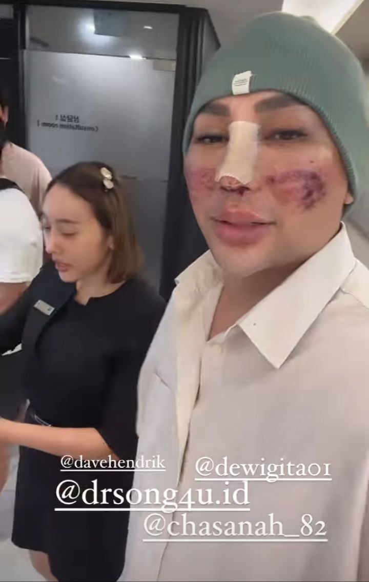 Kondisi Caren Delano Usai Oplas Hidung Di Korea