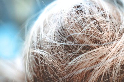 [QUIZ] Dari Masalah Rambut Kamu, Ini Penyakit yang Harus Kamu Waspadai