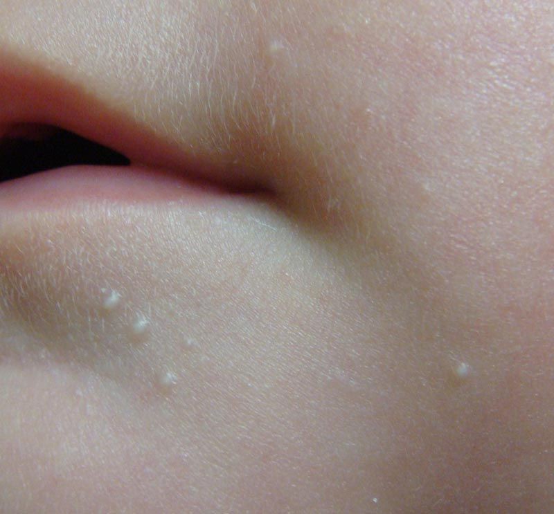 7 Penyebab Benjolan Putih pada Bibir, Apakah Serius?
