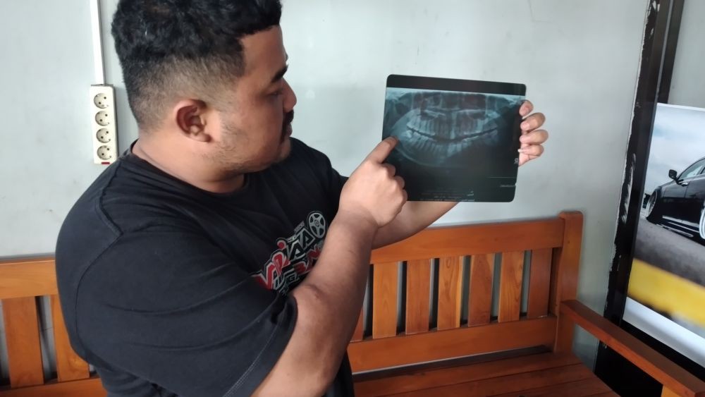 Kasus Cabut Gigi Bungsu Berujung Maut, Begini Kata Kadinkes Ngawi