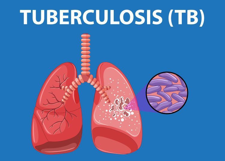 Kemenkes Berikan Lima Mobile X-ray untuk Pelacakan Kasus TB di Jabar 