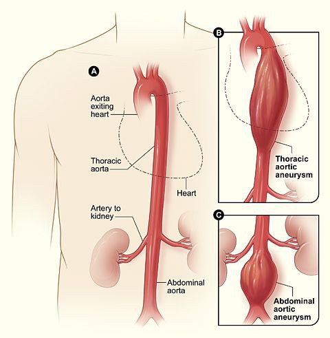 5 Penyakit yang Bisa Menyebabkan Orang Meninggal Mendadak